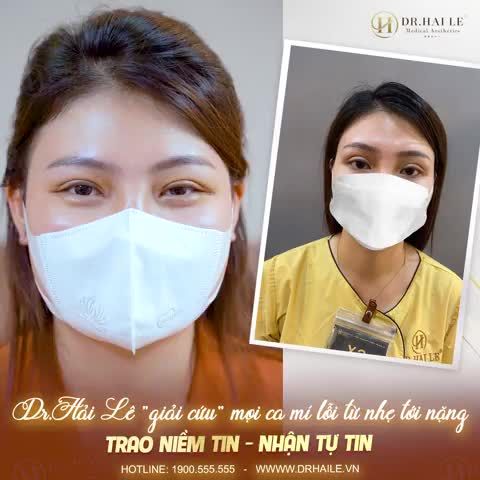 NGAY LÚC NÀY TẠI DR.HẢI LÊ‼️ Những lời chia sẻ không thể nào thật hơn của khách hàng nhà Dr.Hải Lê sau khi trải nghiệm dịch vụ sửa mí.
